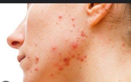 Ese waruzi ko ibiheri byo mu maso bishobora kugira ingaruka ku bwonko?