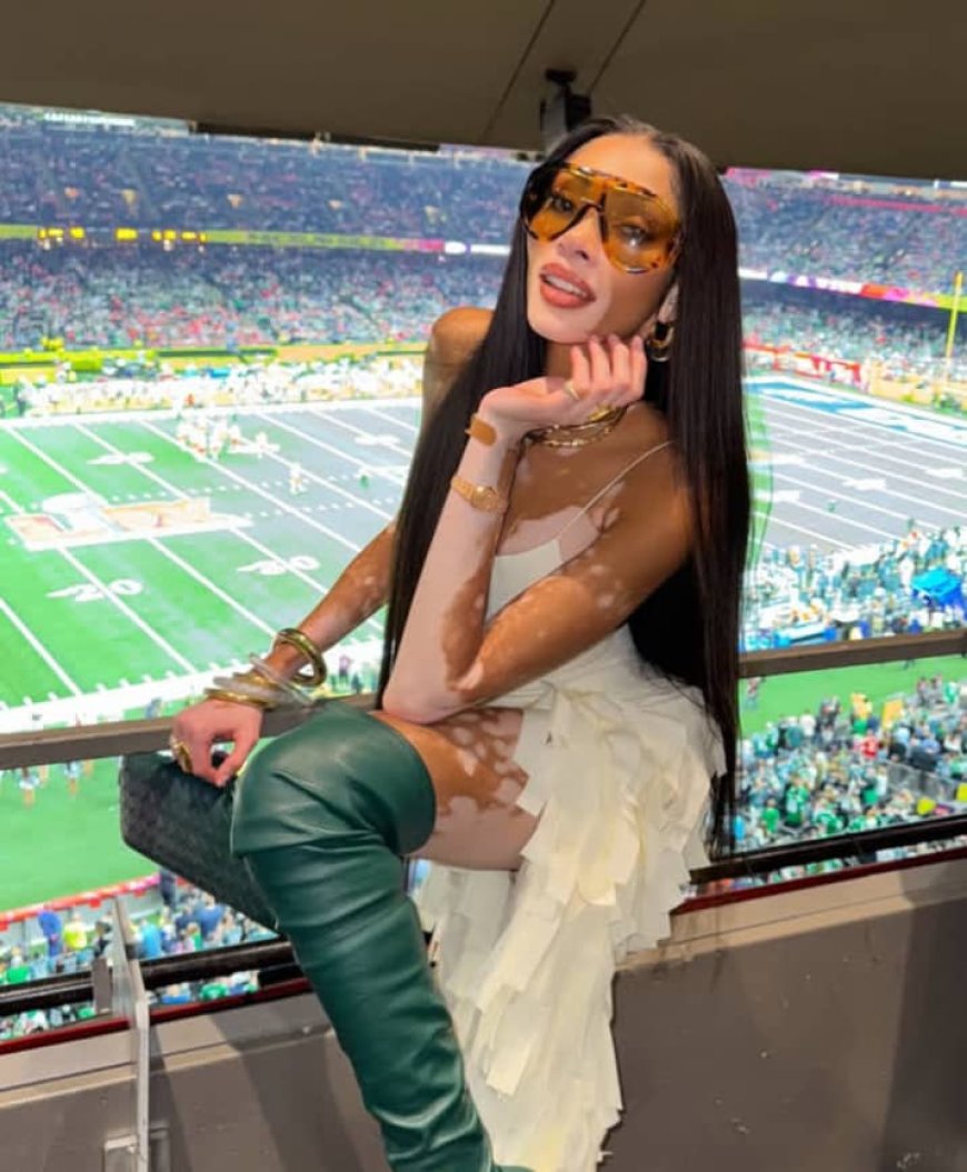 Ubuzima bwa Winnie Harlow urwaye indwara y’ibibara acira abandi inzira -Amafoto