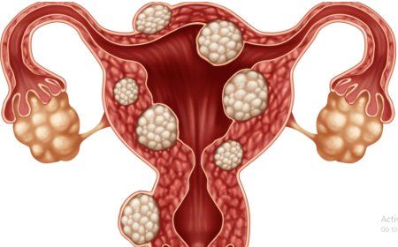 Iyo bikuze agaragara nk' utwite: Ibyo wamenya ku ndwara y'ibibyimba bifata abagore muri nyababyeyi