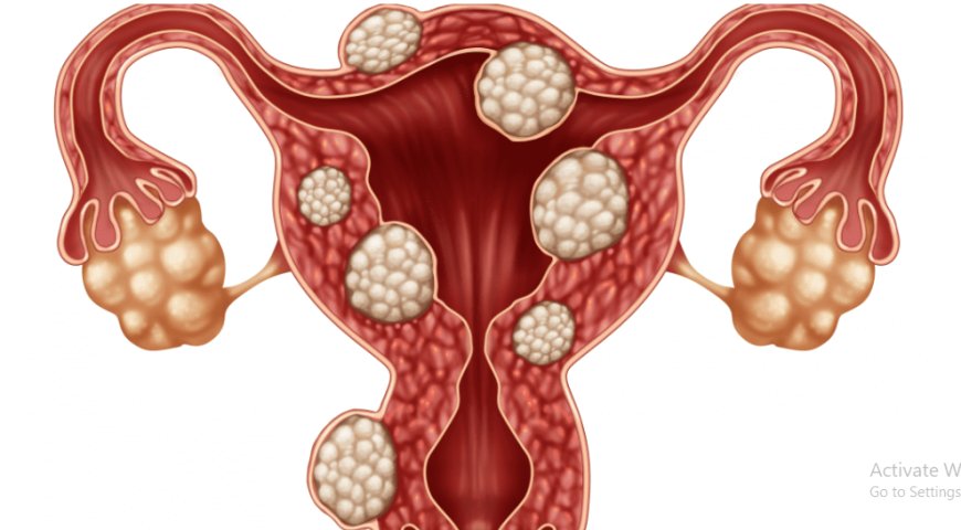 Iyo bikuze agaragara nk' utwite: Ibyo wamenya ku ndwara y'ibibyimba bifata abagore muri nyababyeyi